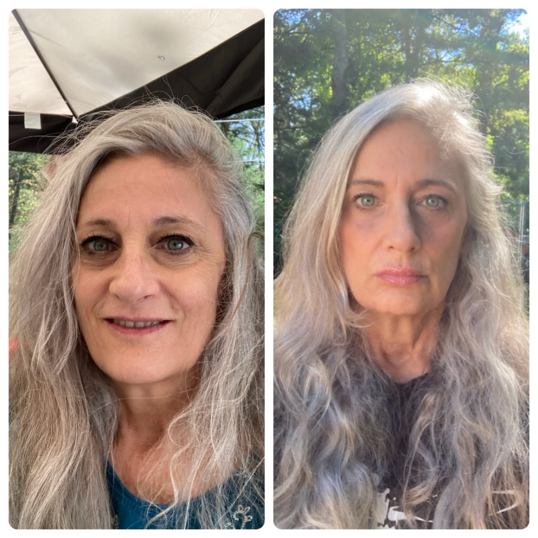 Botox befor and after